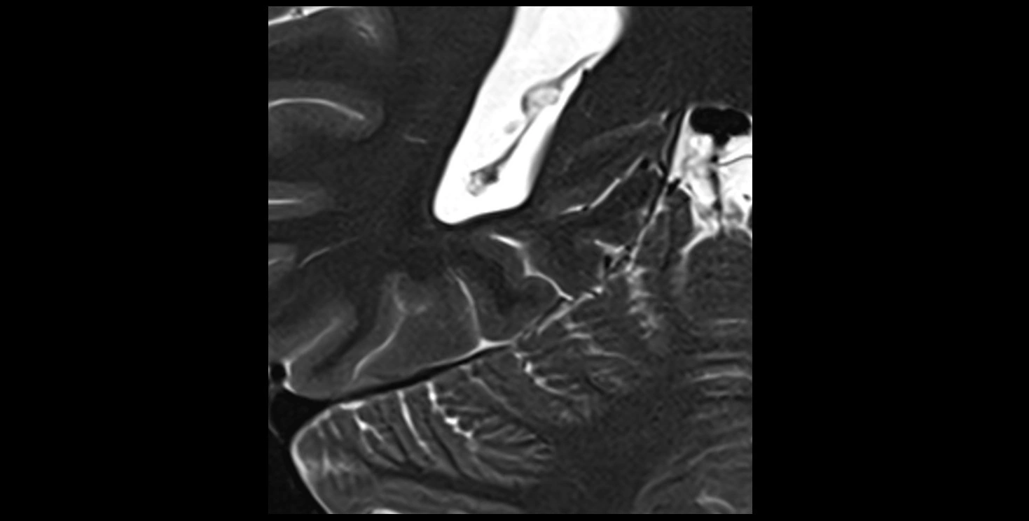Hippocampus anatomy mri coronal cross section 3T MRI image 20.webp